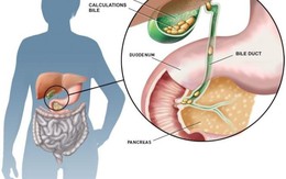 ​Sỏi mật có nguy hiểm không?