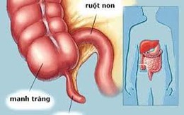 Viêm ruột thừa có thể trị bằng kháng sinh?