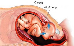 Cứu sản phụ bị vỡ tử cung