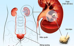 Suy thận - hiểm họa khôn lường từ sỏi thận