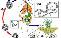 ​Nhiều biến chứng từ bệnh giun chui ống mật