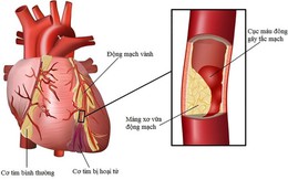 ​Không chủ quan với bệnh máu nhiễm mỡ