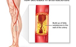 ​Viêm tắc động mạch chi dưới - bệnh lý dễ bị bỏ qua