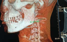 Gắp xương cá nằm 3 tháng trong cổ họng