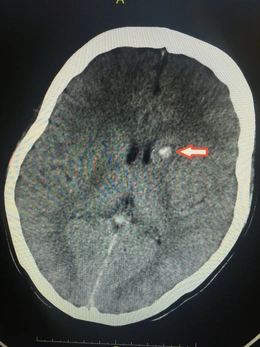 Mông, đùi chảy mủ sau khi tiêm chất làm đầy