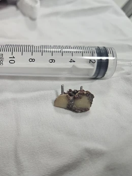 Bỗng dưng mất 2 chiếc răng, 20 năm sau bác sĩ phát hiện trong... phổi