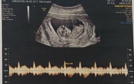 In Vietnam, revealing fetal gender is illegal except in these cases