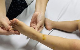 Ho Chi Minh City reports over 44,000 hand, foot and mouth disease cases, 60 samples test positive for EV71