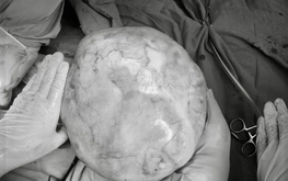 Vietnamese teen girl undergoes surgery to remove 4.3kg ovarian tumor with teeth, hair, bone