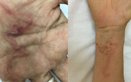 Ghi nhận ca bệnh 'giun rồng' ở Việt Nam, loại giun dài đến hàng mét