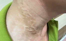 Lại phát hiện ca mắc giun rồng ở Phú Thọ