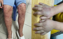 Cảnh báo bệnh ban xuất huyết Schonlein - Henoch gây biến chứng thận nguy hiểm ở trẻ em
