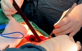 Thanh gỗ đâm xuyên ngực gần 1 gang tay, nam thanh niên thoát chết kỳ diệu