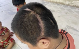 Vụ học sinh lớp 3 bị xe tông tổn thương 90%: Tòa án mời các bên liên quan làm việc lần hai