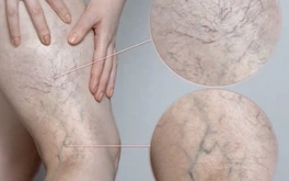 Chân đau nhức, mạch máu lộ rõ cảnh báo bệnh lý đang đe dọa 1/3 người trưởng thành