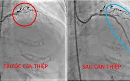 Bệnh viện Tâm Trí Cao Lãnh cứu sống cụ bà bị nhồi máu cơ tim cấp