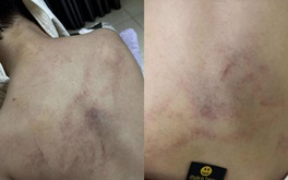 Gia đình tố cô giáo mầm non đánh, kéo lê, ném bé gái 4 tuổi vào tường