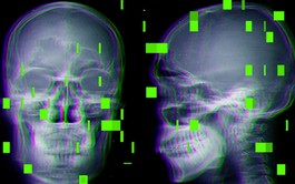 As AI enters the operating room, reports arise of botched surgeries and misidentified body parts