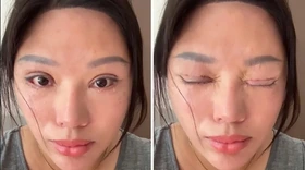 Người phụ nữ không thể nhắm kín mắt suốt 6 năm