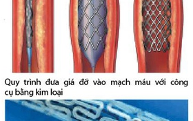 Nong động mạch vành bằng giá đỡ tự tiêu