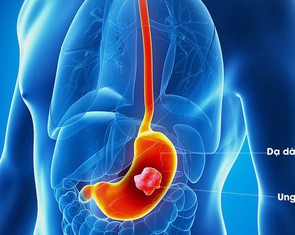 Không nên quá lo lắng tác dụng phụ của hóa trị