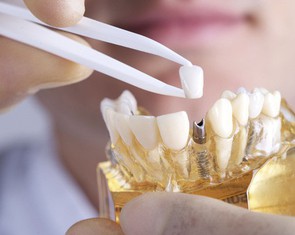 Lắp răng giả có gây ung thư miệng?