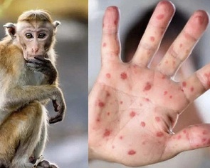 Long An phát hiện ca nhiễm đậu mùa khỉ là nhân viên nhà hàng làm ở TP.HCM