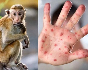Ca nghi mắc đậu mùa khỉ ở Đà Nẵng là tay chân miệng
