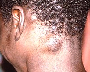 3 sự khác biệt giữa người lớn và trẻ em khi mắc đậu mùa khỉ