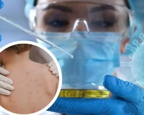 Phát hiện ca đậu mùa khỉ thứ hai ở Thuận An, Bình Dương