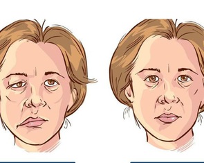 Liệt dây thần kinh số 7 từ ba năm trước, có điều trị khỏi?