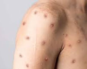 Tiền Giang phát hiện ca bệnh đậu mùa khỉ đầu tiên