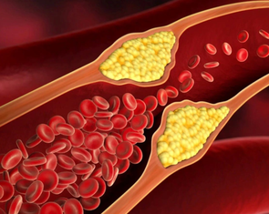 Giảm cholesterol tránh xơ vữa động mạch không cần dùng thuốc, cách nào?