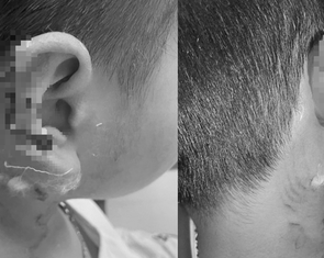 Bé trai 8 tuổi bị chó Phú Quốc vồ, cào mất một phần vành tai