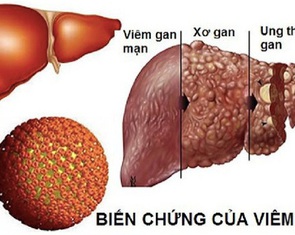 Thực hư việc uống thuốc lá chữa khỏi viêm gan B?
