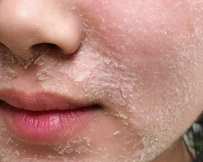 Trào lưu làm đẹp peel da tại nhà có an toàn?