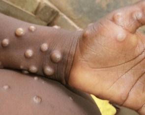 Sức khỏe hai bệnh nhân mắc bệnh đậu mùa khỉ đã ổn định