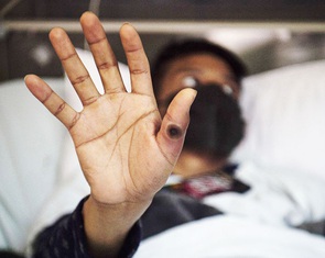 Kiên Giang ghi nhận ba người bị bệnh đậu mùa khỉ