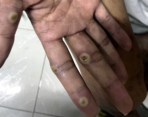 Chàng trai 28 tuổi ở Đồng Nai dương tính với bệnh đậu mùa khỉ