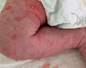 Trẻ sơ sinh mắc thủy đậu lây từ mẹ, cần chú ý ‘thời gian vàng’ điều trị