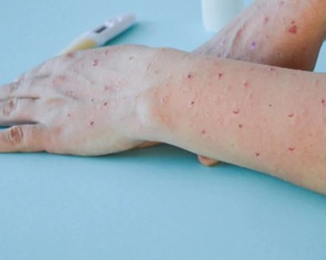 Biến thể mới đậu mùa khỉ nguy cơ lan ra toàn cầu, nguy hiểm ra sao?