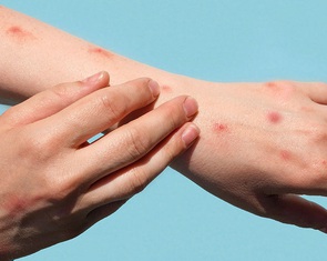 Tổ chức Y tế thế giới họp khẩn vì bệnh đậu mùa khỉ