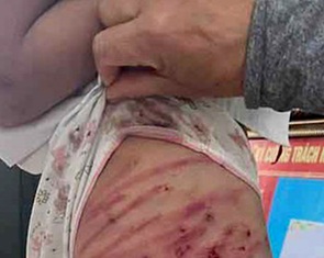 Công an làm việc với người cha dượng liên quan đến bé gái lớp 5 nghi bị bạo hành