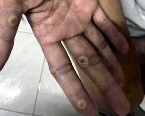 Đồng Nai xuất hiện ca đậu mùa khỉ chưa rõ nguồn lây, ngành y tế khẩn trương truy vết