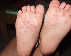 TP.HCM: Tay chân miệng vào mùa, cảnh báo nguy cơ dịch chồng dịch