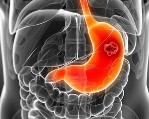 Cách trị viêm loét dạ dày - tá tràng qua bữa ăn