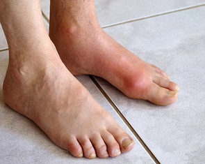 Chàng trai trẻ mắc bệnh gout ở tuổi 22, dấu hiệu cảnh báo từ đau khớp cổ chân