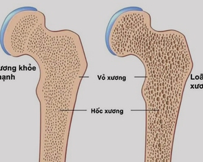 Làm gì để phòng ngừa bệnh loãng xương?