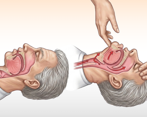 Đừng kéo lưỡi khi cấp cứu 'nuốt lưỡi'