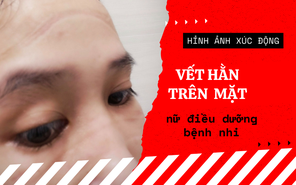 Hình ảnh xúc động: Vết hằn trên khuôn mặt của nữ điều dưỡng bệnh nhi